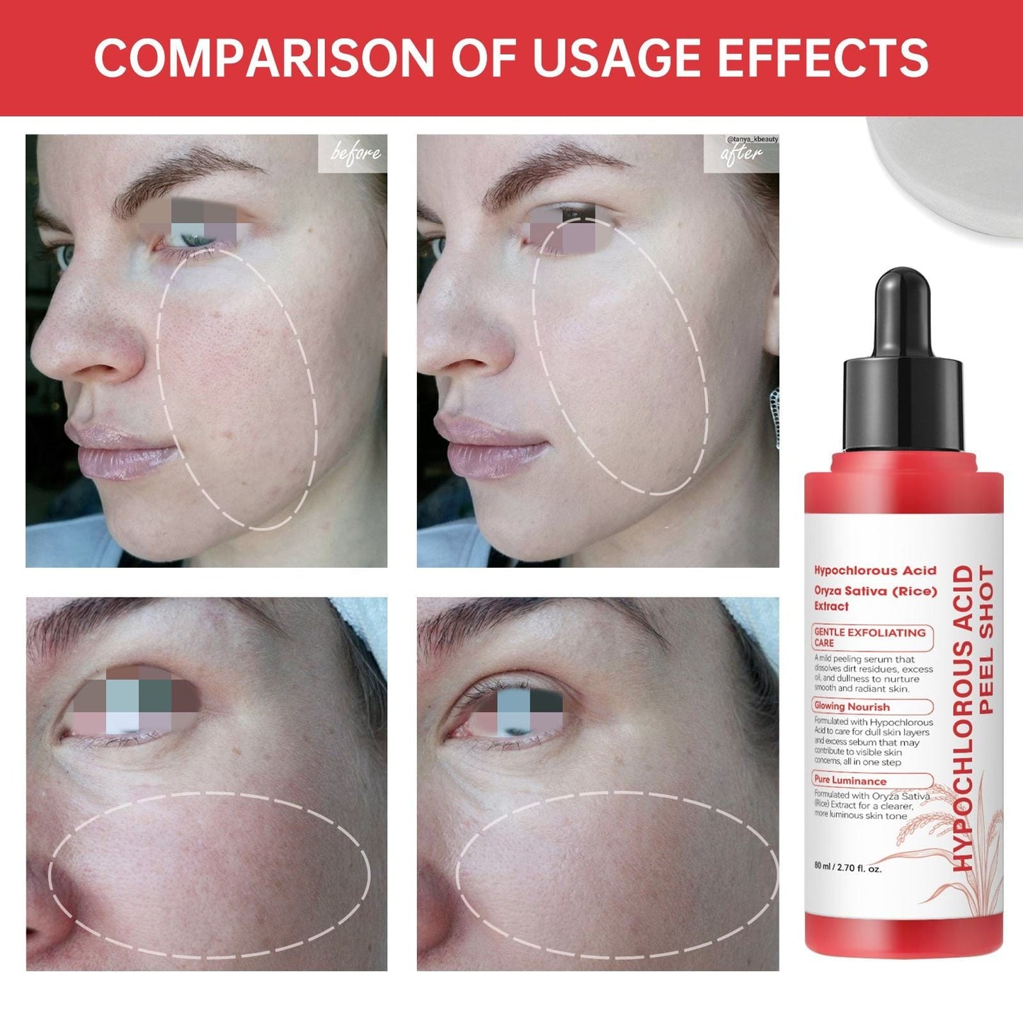 HYPOCHLOROUS ACID PEEL SHOT AND HYPOCHLOROUS ACID BODY PEEL SHOT